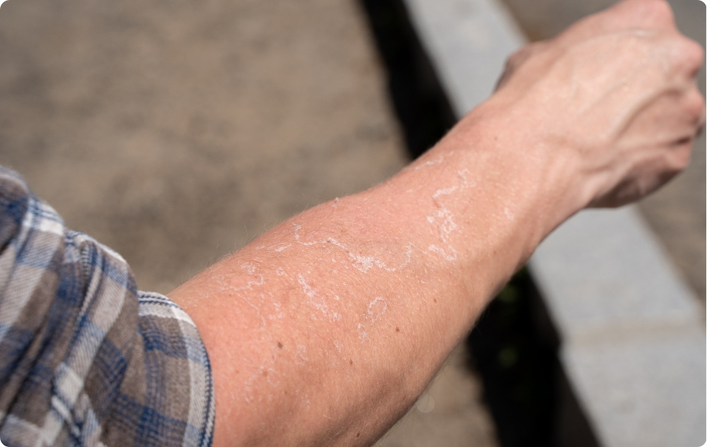 Als olie voor geïrriteerde en droge huid